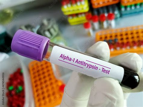 alpha 1 antitrypsin blood test bottle|alpha 1 antitrypsin normal levels.